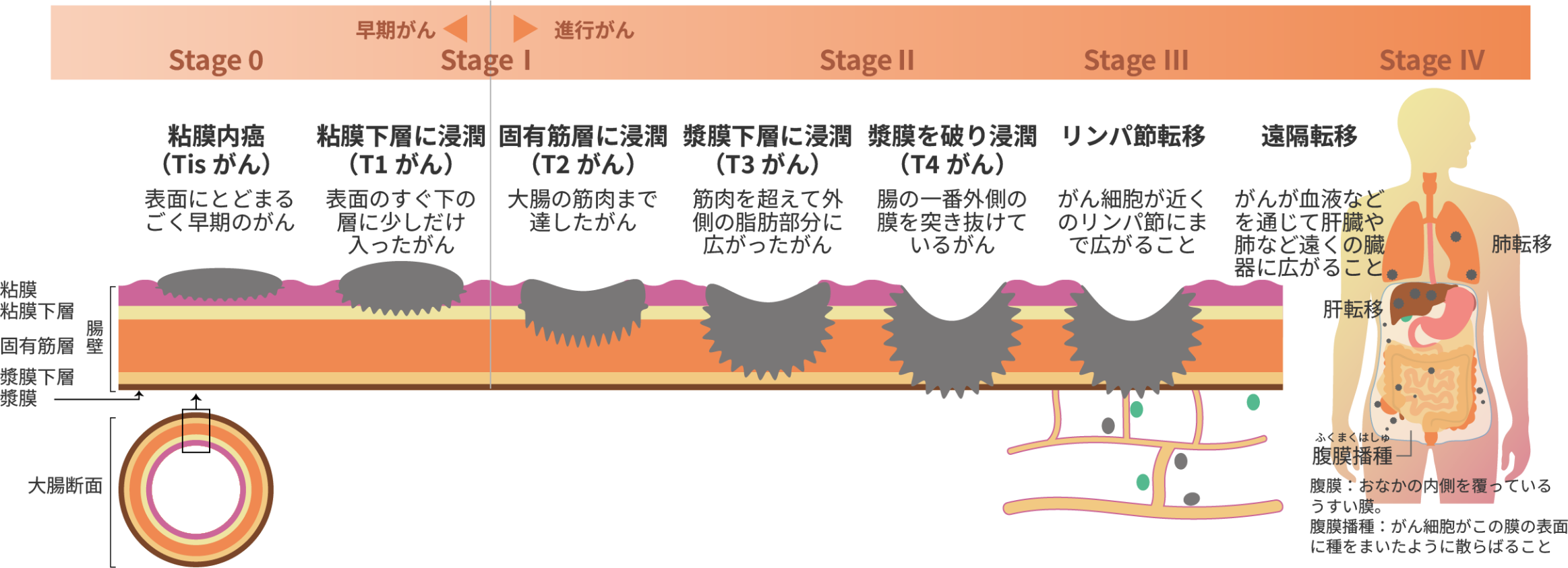 [早期がん]粘膜内がん・粘膜下層に浸潤[進行がん]固有筋層に浸潤・漿膜下層に浸潤・漿膜を破り浸潤・リンパ節転移・遠隔転移